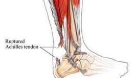 吃瓜画跟腱,跟腱损伤背后的真相与预防之道