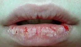 吃白瓜嘴唇疼,小心嘴唇疼痛困扰