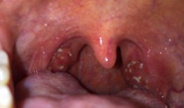 吃白瓜喉咙难受,揭秘食用禁忌与应对策略